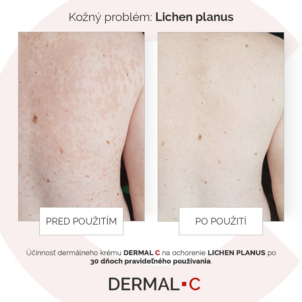 Lichen planus po pravidelnom používaní DERMAL C