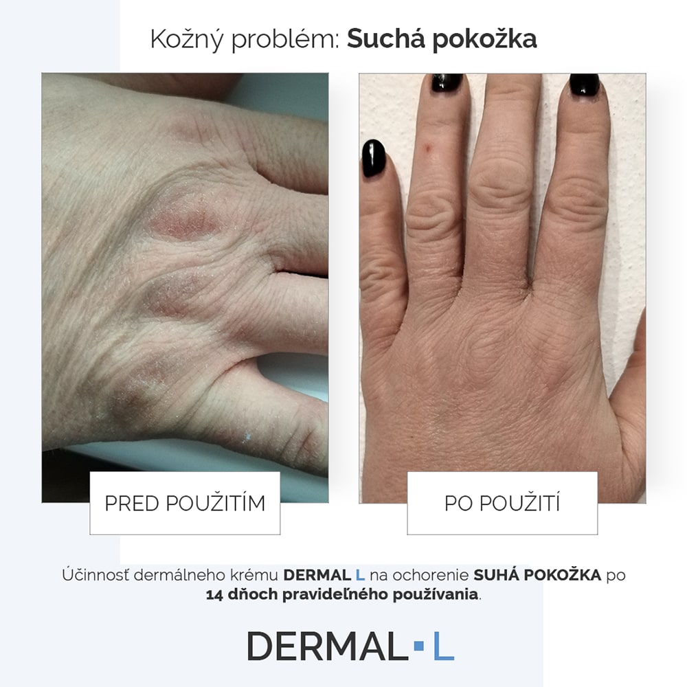 Suchá pokožka rúk po pravidelnom používaní DERMAL L