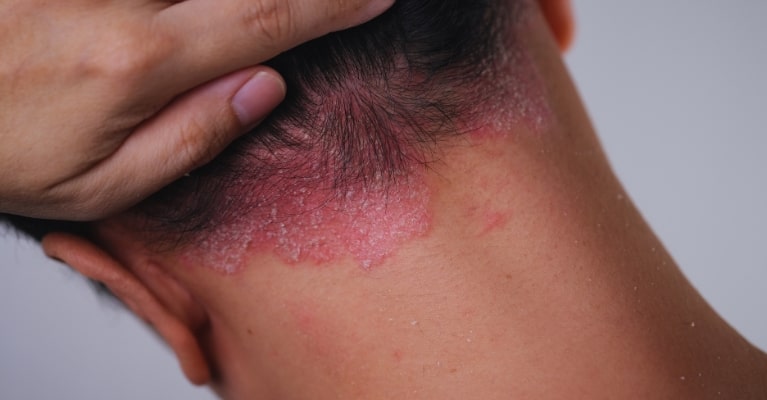 Psoriáza vo vlasoch: Príznaky, liečba a účinná prírodná starostlivosť